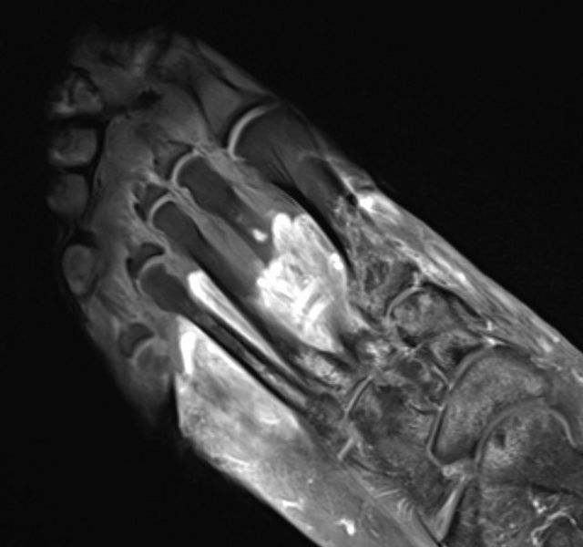 MRI do pé de um paciente com covid-19 grave. A parte cinza é um tecido desvitalizado (gangrena)