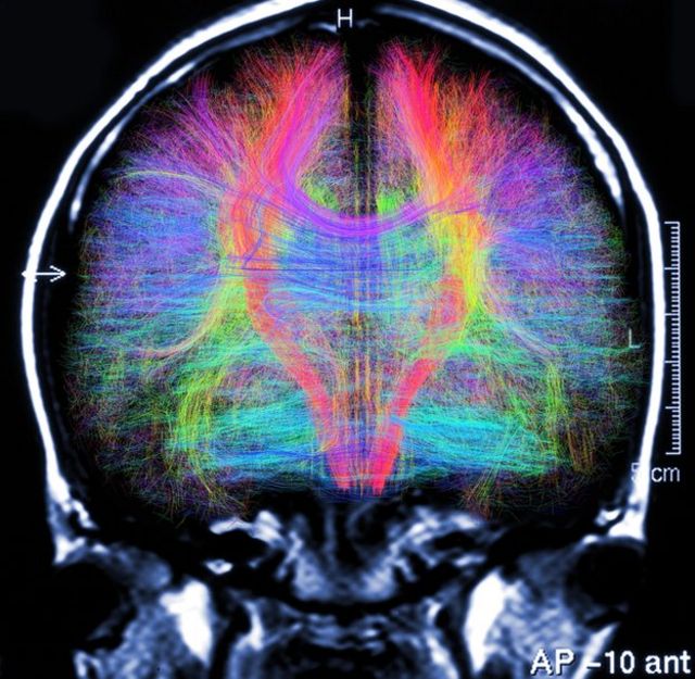 Escáner cerebral