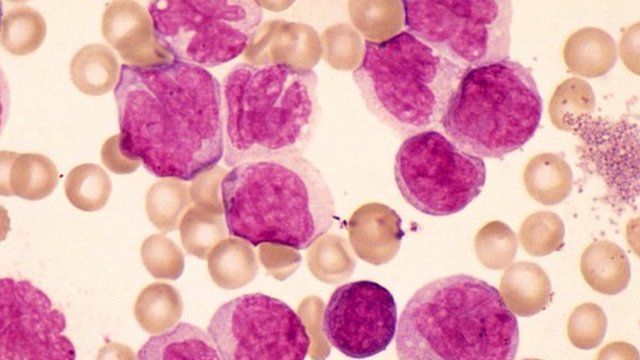 Chronic myeloid leukaemia is a rare blood cancer.