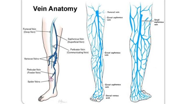 வெரிகோஸ்