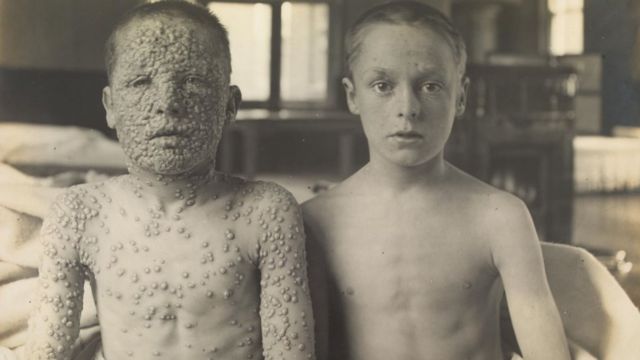 Dos hermanos, uno vacunado y otro no, fotografiados en el pabellón de aislamiento en el hospital de Leicester.