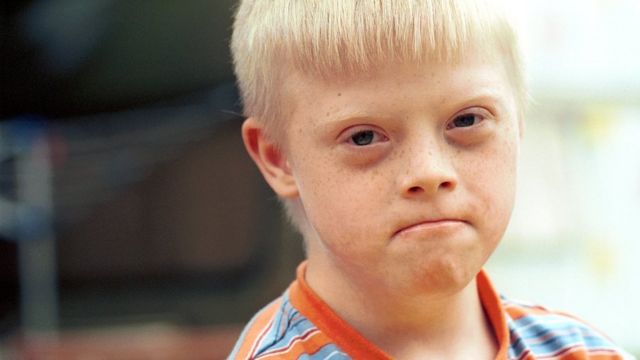 Niño con síndrome de Down.