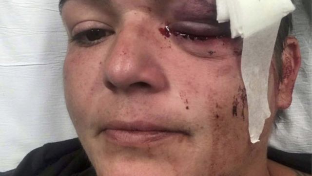 Phóng viên ảnh tự do Linda Tirado bị đánh vào mặt khiến một mắt của bà bị hỏng không thể chữa được