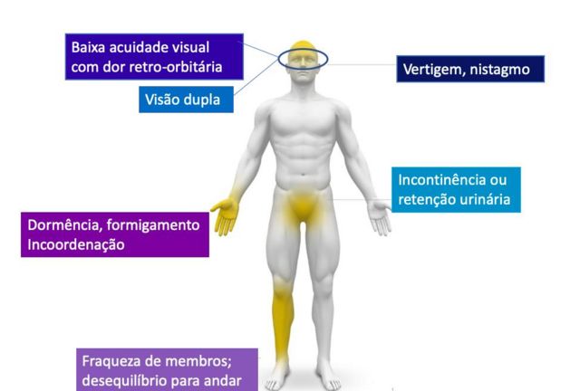 Ilustração de sintomas da esclerose múltipla