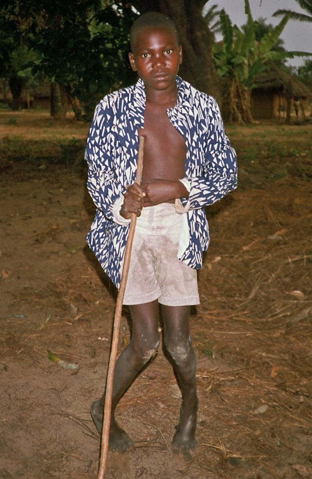 A boy with Konzo, photographed in Zaire in September 1986