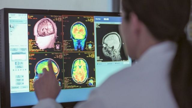 மூளை மாற்று அறுவை சிகிச்சை