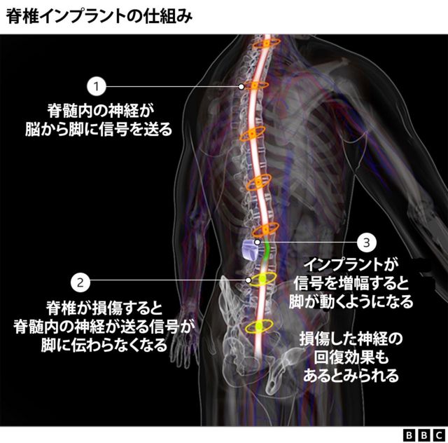 脊髄損傷で下半身まひの男性、インプラントで歩行可能に＝スイス研究