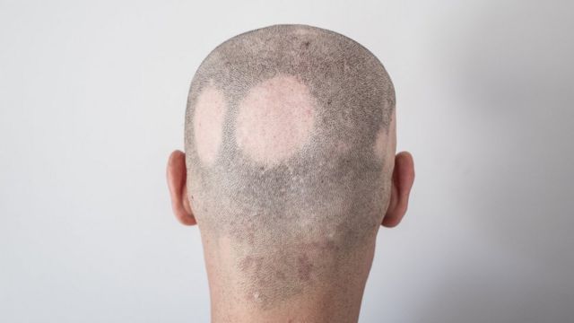 Hombre con alopecia areata, que acabó con áreas calvas en el cuero cabelludo.