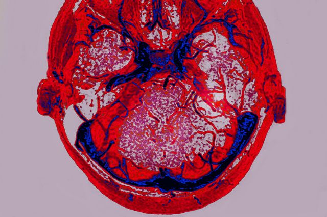 Церебральний венозний тромбоз на скані головного мозку