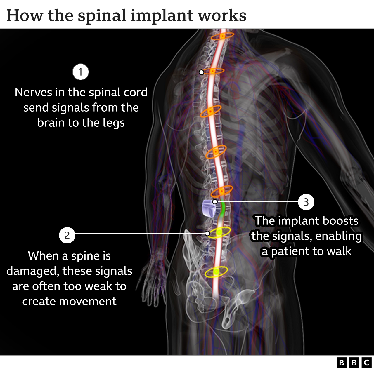 How implant make spinal cord injury patient to start to walk again