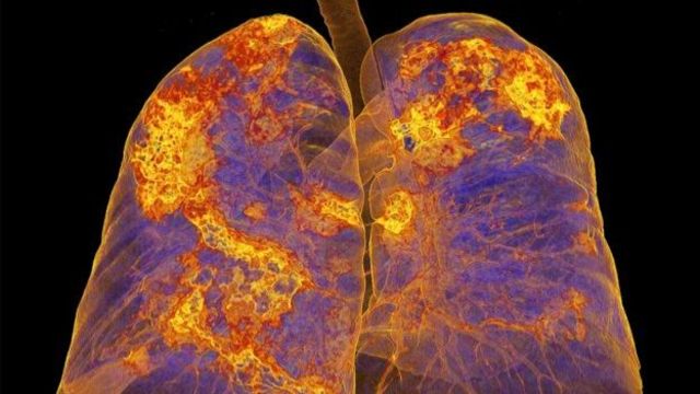 感染新冠病毒患者的肺部(photo:BBC)