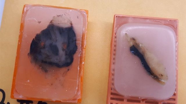 Tumores de melanoma acral embebidos en parafina