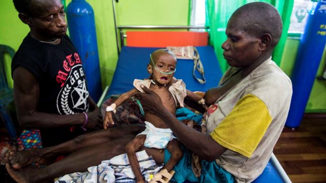 Campak dan kelaparan di Asmat: ke mana APBD triliunan? - BBC News Indonesia