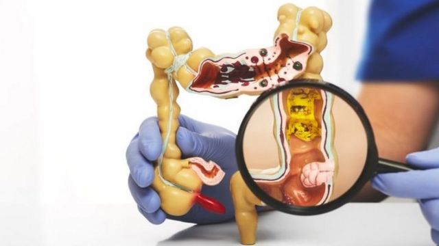 Fahamu maradhi hatari ya Diverticular