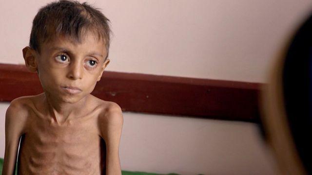 Un niño severamente desnutrido en Yemen