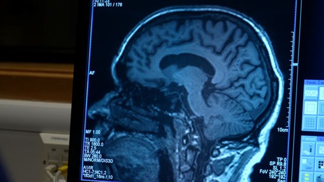Brain scan of Aldo Ceresa, a patient with Alzheimer's disease in the United Kingdom