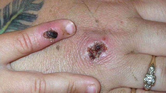 A monkeypox lesion on a patient's hand.