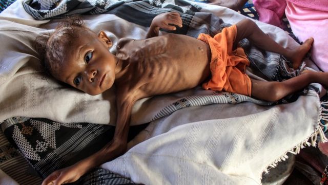 أطقال اليمن يتعرضون لامراض سوء التغذية بفعل الحرب وشح الغذاء