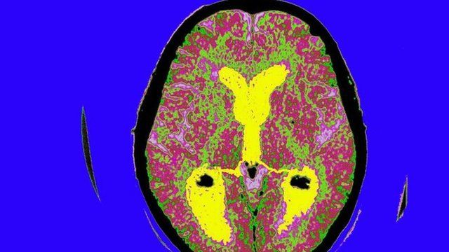 Cérebro de paciente de Alzheimer
