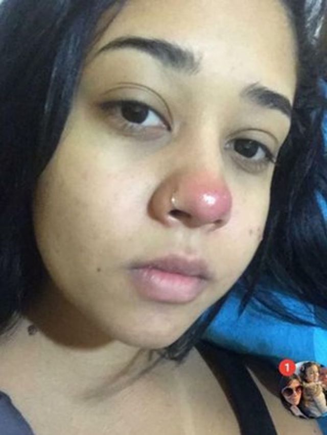 Quanto tempo demora para cicatrizar o piercing no nariz Saude Fiquei Paraplegica Por Causa De Um Piercing Bbc News Brasil