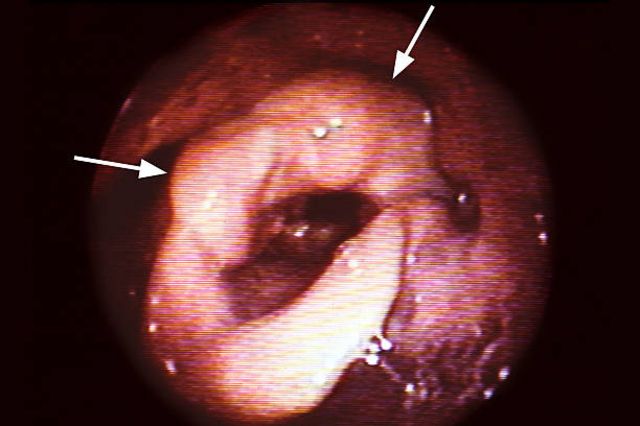 Throat Cancer