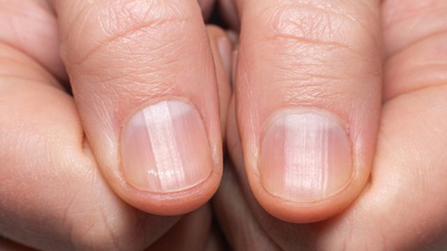 Cómo tus uñas te advierten sobre tu salud y ayudan a detectar enfermedades   BBC News Mundo