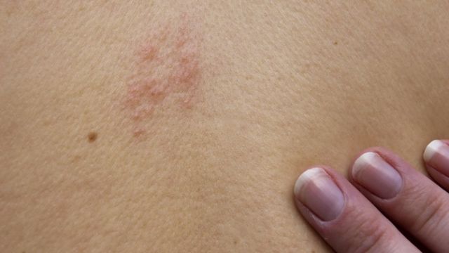 Herpes-zóster, a doença causada pelo vírus da catapora que pode ser ...