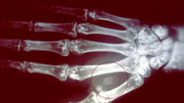 microchip implantado en la mano