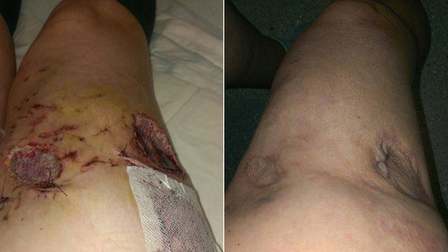 Kerry Stevens' injuries