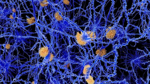 Что происходит в мозгу больного Альцгеймером?