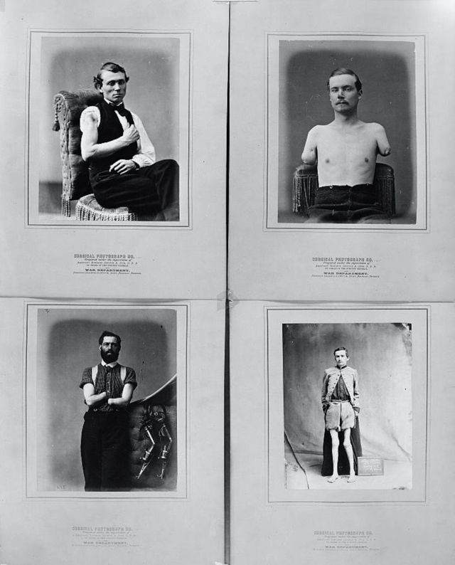 Muitos soldados que lutaram na Guerra Civil enfrentaram amputações e sequelas permanentes. A imagem mostra quatro feridos fotografados entre 1861 e 1865