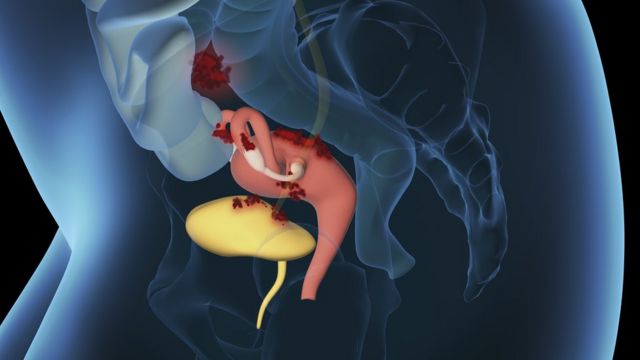 Representação 3D de endometriose