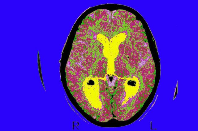 scáner de persona con alzéhimer