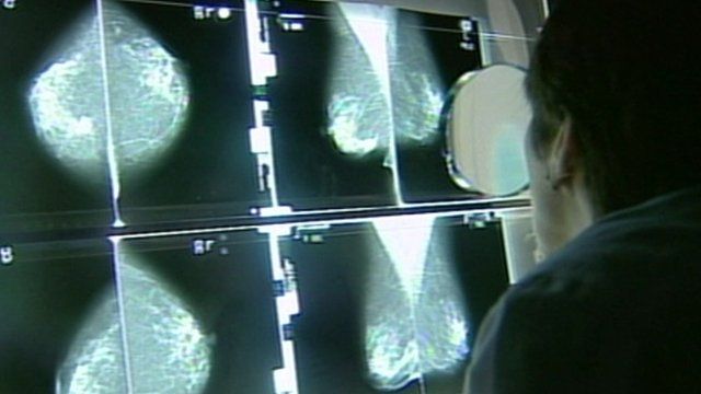 A doctor examines scans for signs of breast cancer