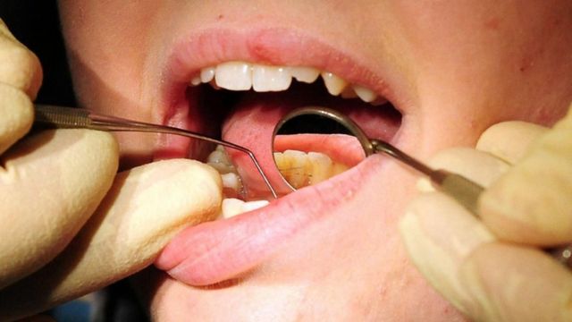 如果不注意，牙周炎会导致牙齿脱落，同时也会带来健康风险。(photo:BBC)