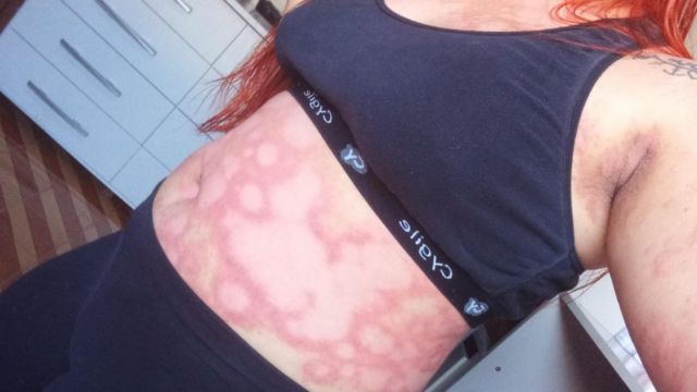 Caroline shows a rash caused by psoriasis
