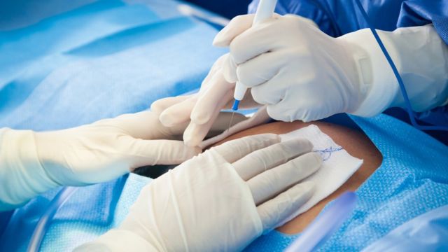 தாயால் முடியாத கட்டத்தில் மட்டுமே அரசு மருத்துவமனைகளில் சிசேரியன் பிரசவம் பரிந்துரைக்கப்படும்