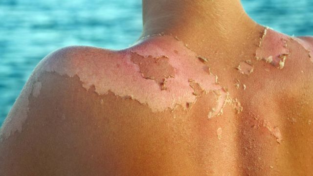 La aplicación que te dice cuánto tiempo puedes exponerte al sol sin  quemarte la piel - BBC News Mundo