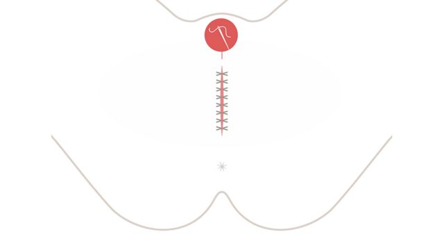 Gráfico que muestra la infibulación con la vagina cosida