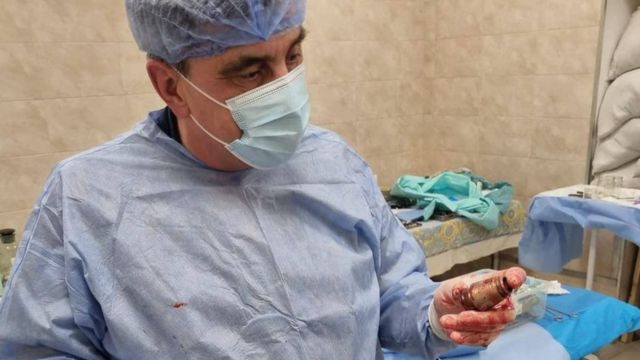 Surgeon Andrey Verba shows the grenades after surgery.