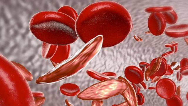 افراد مبتلا به بیماری کم‌خونی داسی‌شکل دارای گلبول‌های قرمز خون تغییر‌شکل‌یافته هستند که باعث بروز مشکلاتی در بدن آنها می‌شود