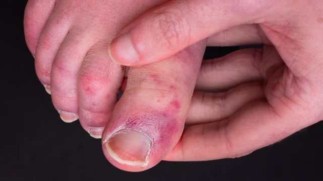 Study reveals why some people get Covid toe condition - BBC News