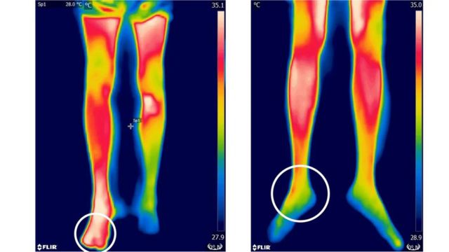 تظهر مواضع الالتهاب الناتجة عن التسمم جراء التعرض للدغات الثعابين في صورة نقاط ساخنة في الصور الملتقطة بالكاميرا الحرارية (يسارا) مقارنة بالأجزاء التي لم تتعرض للتسمم
