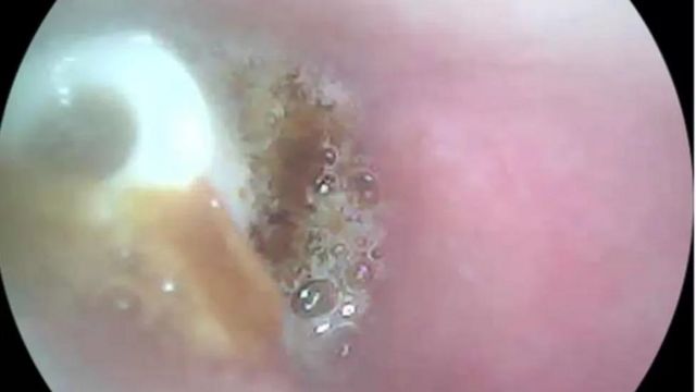 காதுக்குள் சிக்கியிருந்த ஏர்பாட்ஸ்