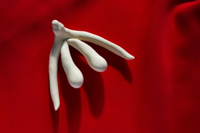 Clitoromegaly: Tori of one young woman wey explain why she do surgery to reduce di clitoris