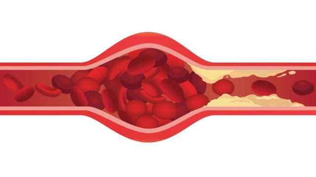 Ilustración de una arteria obstruida por un coágulos.