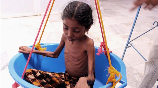 صورة أرشيفية لطفلة أخرى من محافظة الحجة اليمنية.