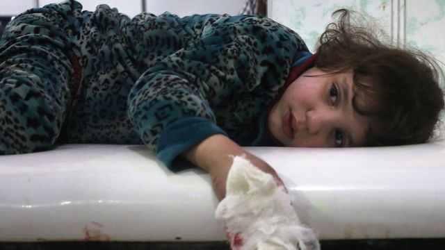طفلة مصابة في الغوطة