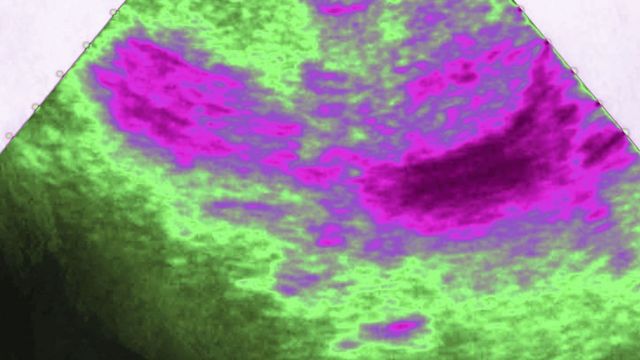 Échographie gynécologique. Métrorragie, hémorragie utérine avec caillots de sang dans le vagin avant une fausse couche.