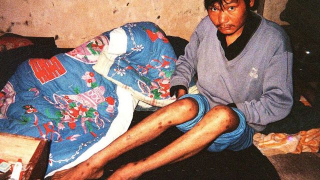 这名29岁的男子2000年因为卖血感染了艾滋病毒。他从16岁开始卖血攒钱，为家里盖房子。